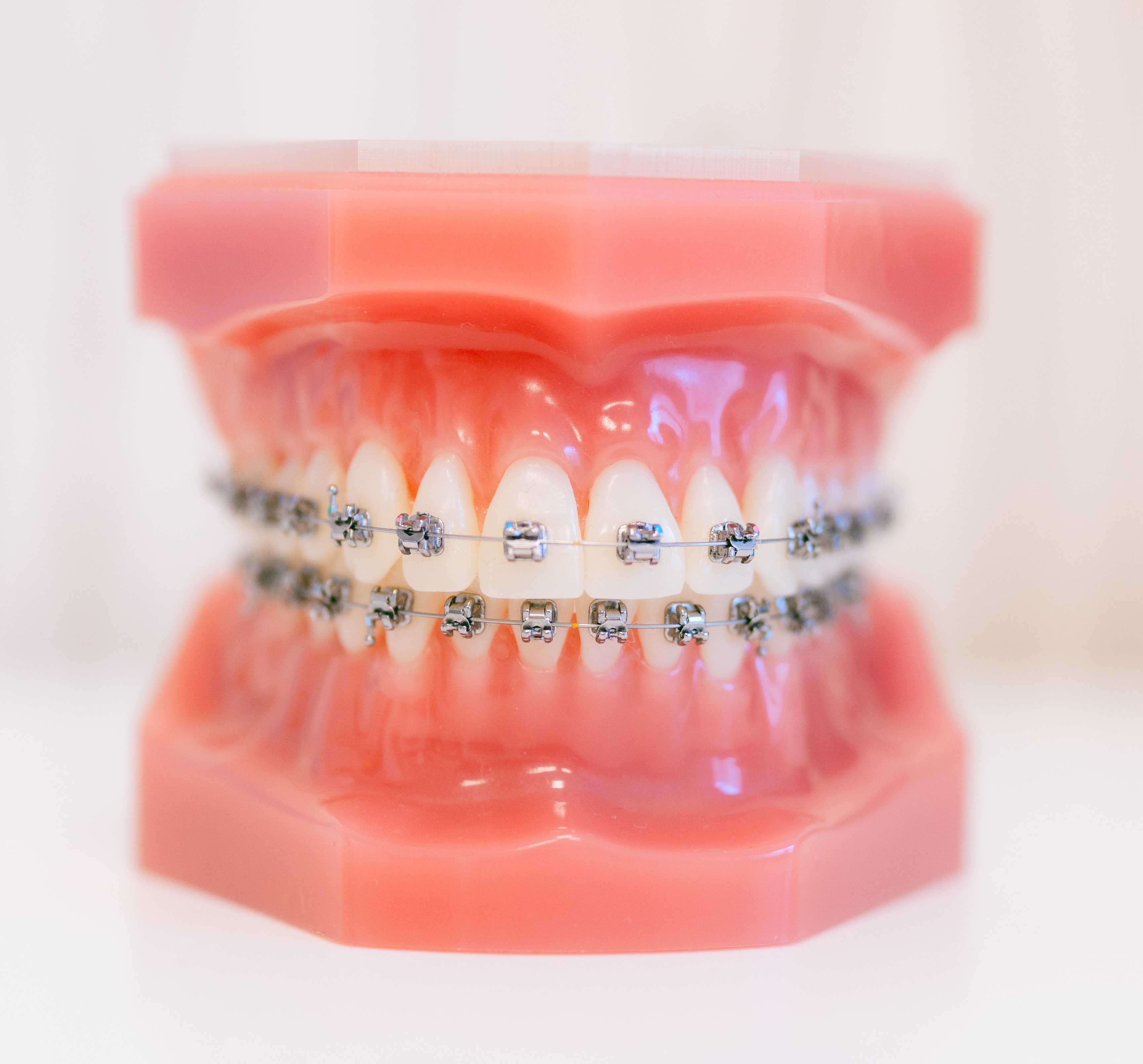 Traitement interception orthodontique