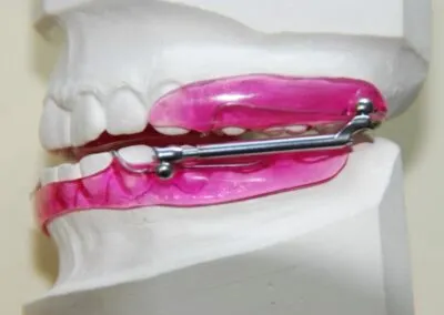 Traitement orthodontique
